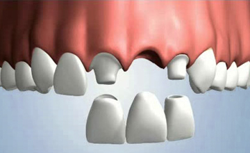 FamilySmiles Dental bridge service