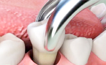 FamilySmiles Dental Tooth Extractions service