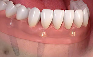 FamilySmiles Dental Implant Therapy service