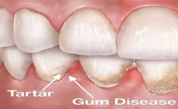 FamilySmiles Dental Periodontal (Gum) Disease service