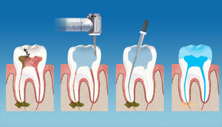 FamilySmiles Dental Endodontics Therapy service