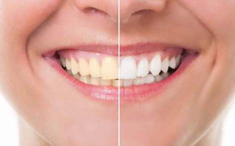 FamilySmiles Dental teeth whitening Therapy service
